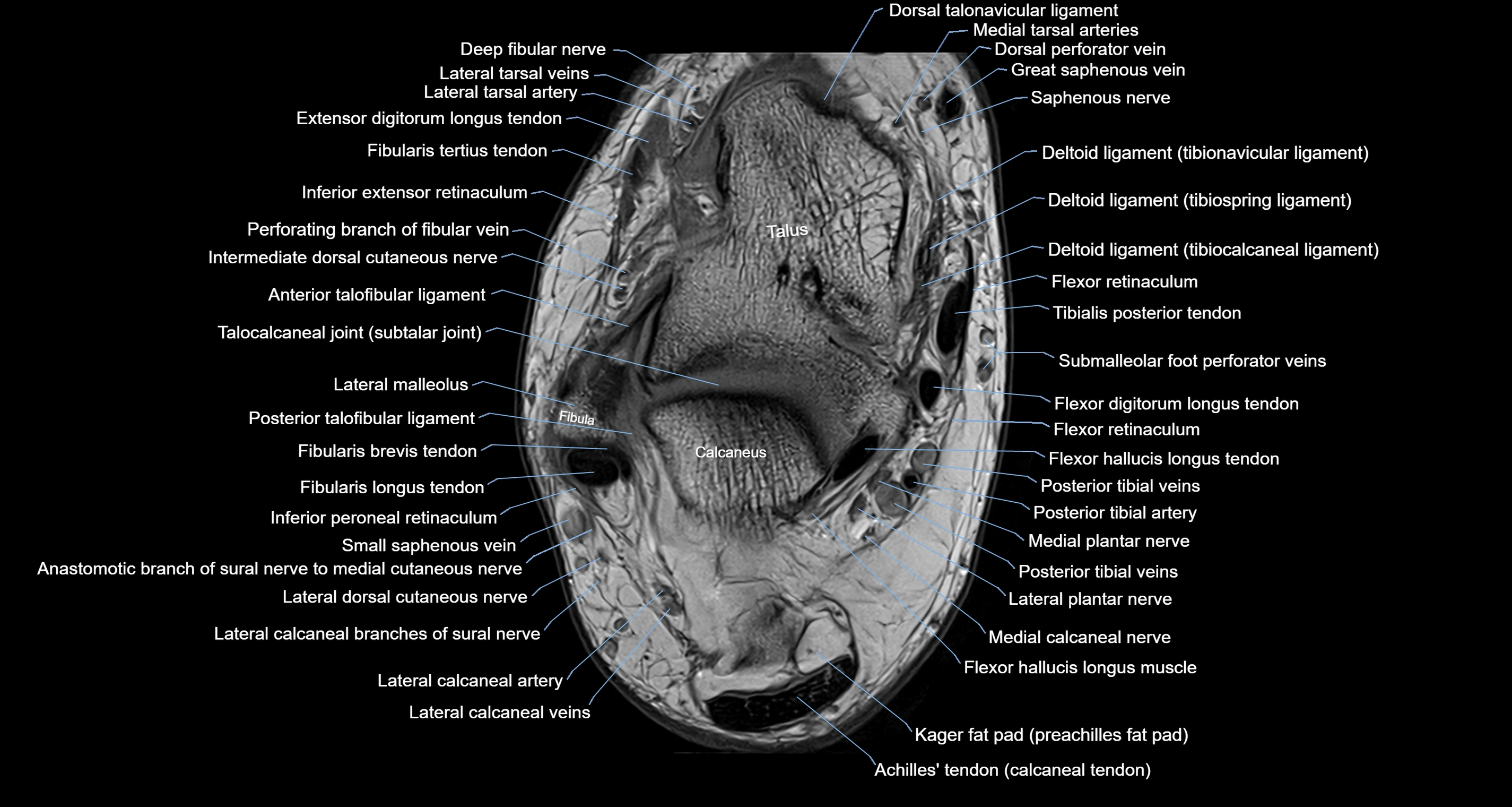 Ankle axial anatomy 3T MRI images -img-10001-00021.webp